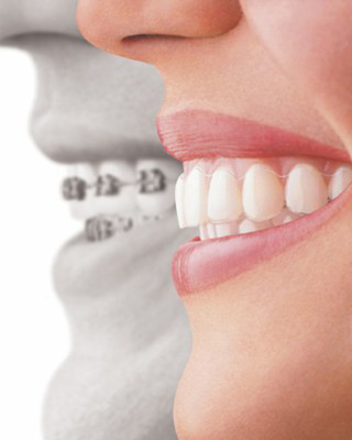 Invisalign braces comparison with metal braces