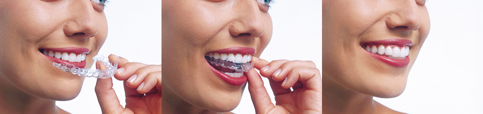 Young girl wearing metal braces