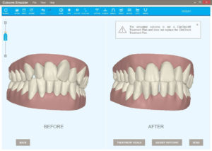 Before and After Invisalign Treatment