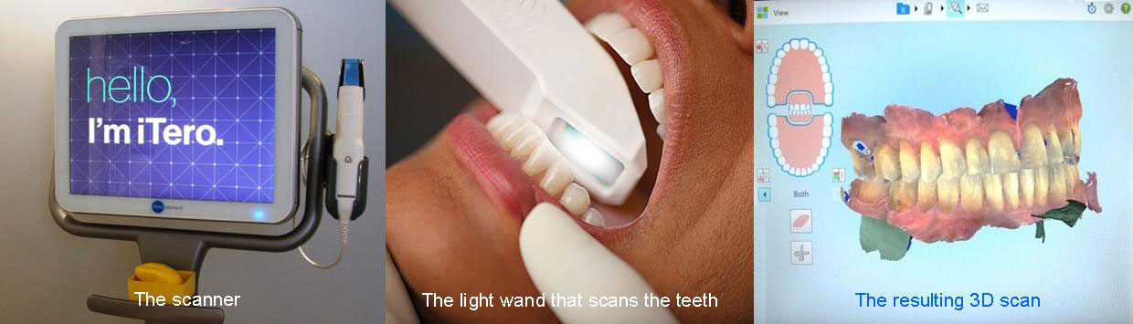 Invisalign 3D scanning for record taking