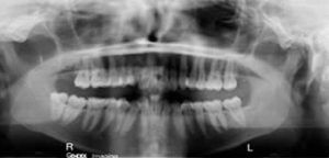 Mouth X-Ray